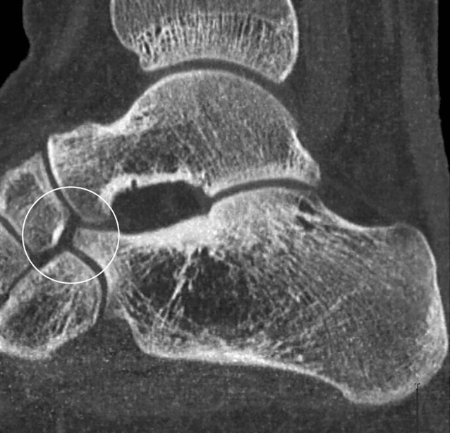 Удлинённый передний отросток пяточной кости (Elongated Anterior Process of Calcaneus)