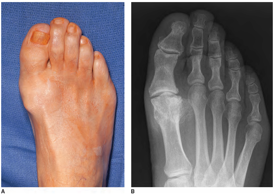 Рис. 9. Внешний вид и рентгенография пациента с hallux rigidus (продолжение)