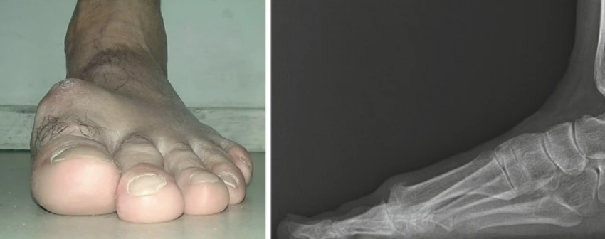 Hallux rigidus — ограничение тыльного сгибания Рис. 2. Hallux rigidus — ограничение тыльного сгибания, вид сбоку