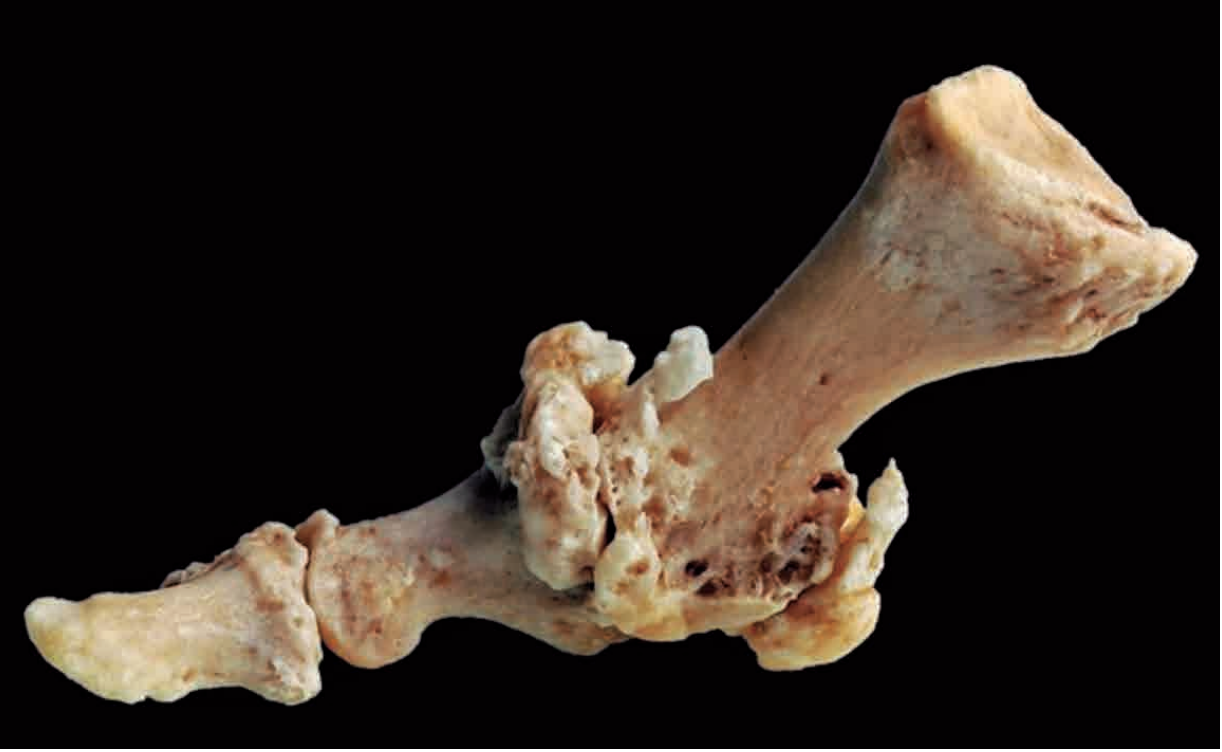 Hallux Rigidus (артроз первого плюснефалангового сустава)