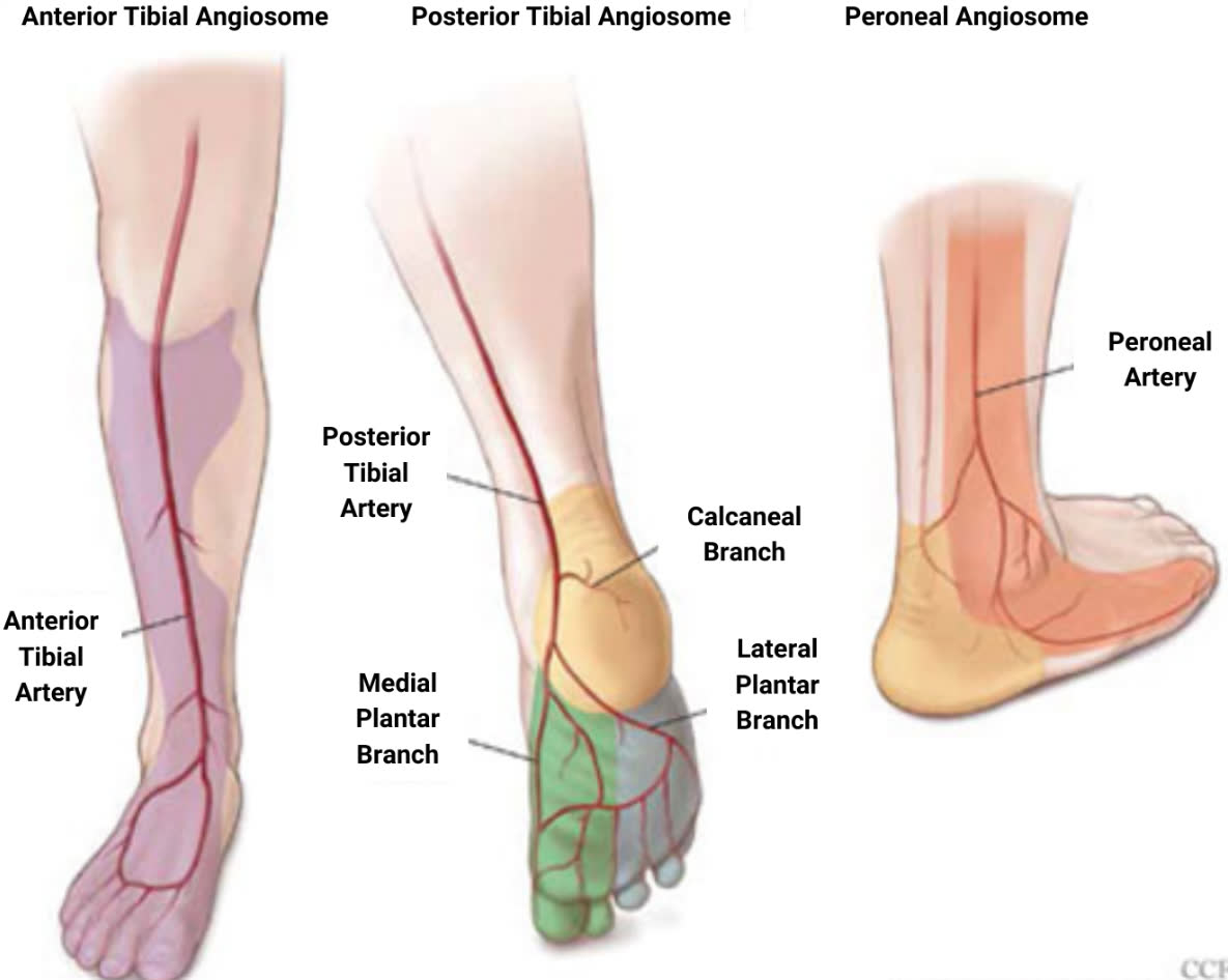 Рис. 3. Ангиосомы в области голеностопного сустава