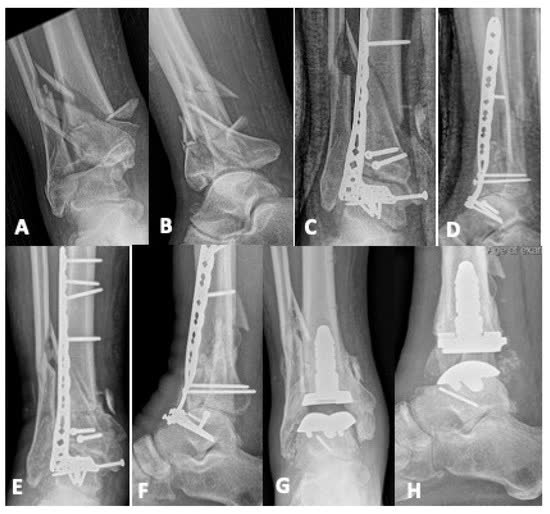 Рис. 33. Эндопротезирование после неудачного остеосинтеза перелома пилона