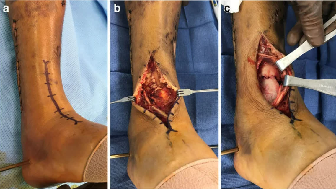 Рис. 17. Переднелатеральный доступ к голеностопному суставу