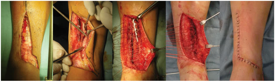 Рис. 19. Переднемедиальный доступ к голеностопному суставу