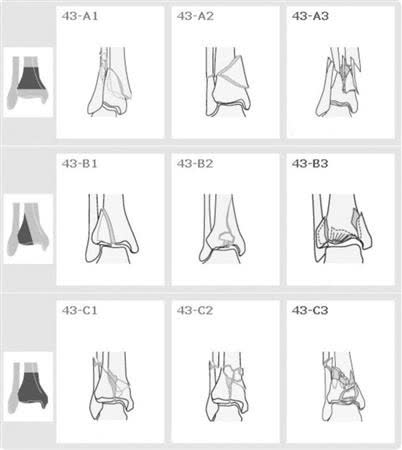 Рис. 7. Классификация AO/OTA переломов пилона
