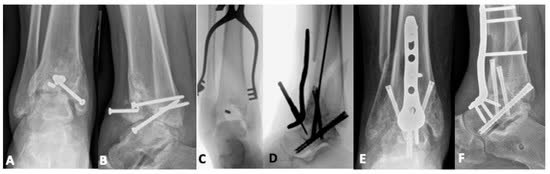 Рис. 37. Артродез передней пластиной после остеосинтеза перелома пилона
