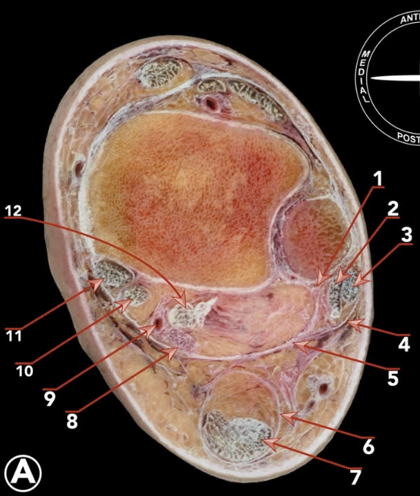 Рис. 13. Аксиальный срез голеностопного сустава на КТ