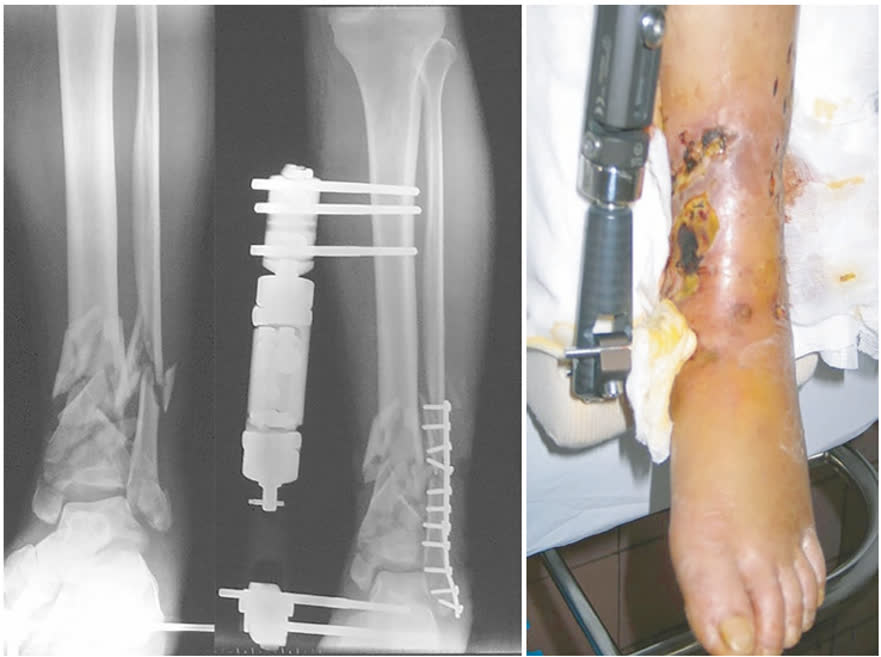 Рис. 31. Остеосинтез малоберцовой кости первым этапом в сочетании с АВФ