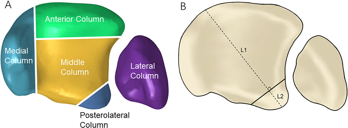 Рис. 11. Пятиколонная классификация переломов пилона (Liu, 2025)