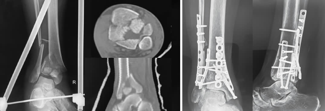 Рис. 25. Фрагмент-специфическая фиксация перелома пилона