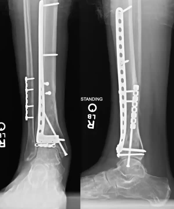 Рис. 27. Фиксация с использованием опорной конструкции в виде пластины