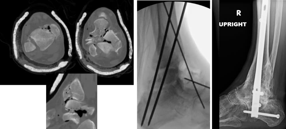 Рис. 35. Первичный артродез при сочетанном переломе пилона с таранной костью
