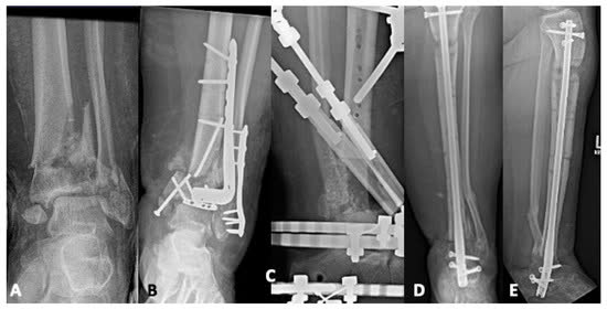 Рис. 39. Ревизионный артродез после перелома пилона
