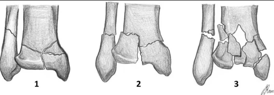 Рис. 5. Классификация Rüedi-Allgöwer переломов пилона
