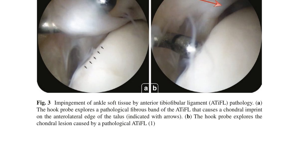 Рис. 3. Артроскопическая картина импиджмента нижним пучком передней межберцовой связки (ATiFL, связка Бассетта): (a) зонд исследует патологический фиброзный тяж ATiFL, вызывающий хрящевой отпечаток на переднелатеральном крае таранной кости (стрелки); (b) хрящевое повреждение, вызванное патологическим ATiFL. Адаптировано из Wagner, 2022
