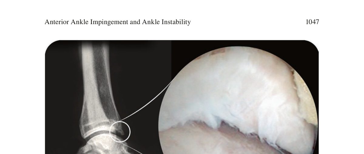 Рис. 1. Рентгенологическая и артроскопическая картина переднего остеофита большеберцовой кости, связанного с хронической нестабильностью голеностопного сустава. Остеофит формы «клюва попугая» (parrot beak) по всему переднему краю большеберцовой кости. Адаптировано из Wagner, 2022