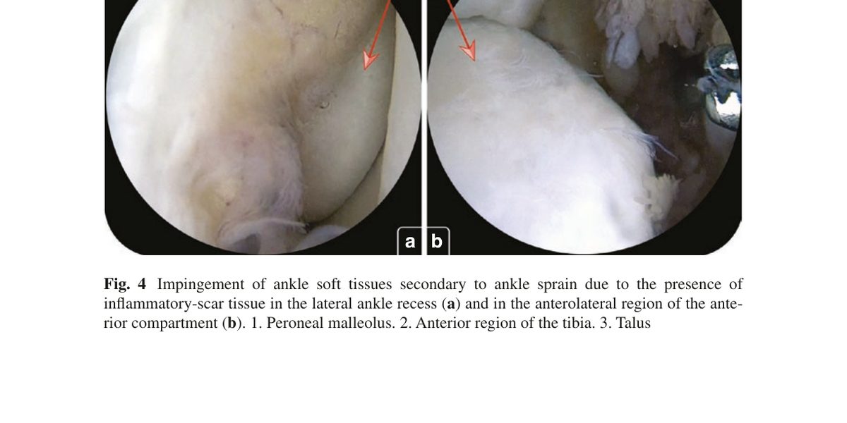 Рис. 4. Артроскопическая картина мягкотканного импиджмента после растяжения связок: (a) воспалительно-рубцовая ткань в латеральном кармане; (b) переднелатеральная область переднего компартмента. 1 - малоберцовая кость, 2 - передний край большеберцовой кости, 3 - таранная кость. Адаптировано из Wagner, 2022