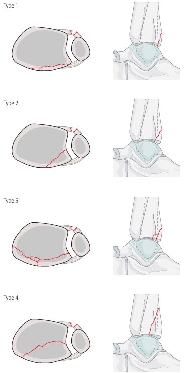 Рис. 9. Классификация переломов заднего края по Bartonicek и Rammelt