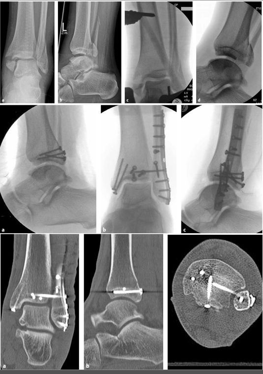 Рис. 22. Этапное лечение трёхлодыжечного перелома. Наложен АВФ для обеспечения покоя мягким тканям и первичной репозиции. Далее — интраоперационный и КТ-контроль выполненного остеосинтеза. Обратите внимание на корректное положение малоберцовой кости в вырезке