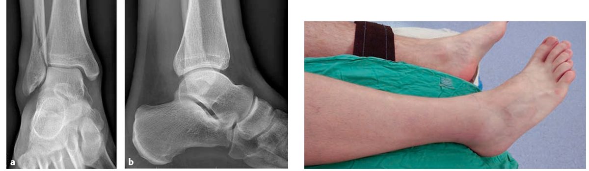 Рис. 19. Клинический пример перелома типа В. Обратите внимание на состояние мягких тканей: практически полностью отсутствует отёчность