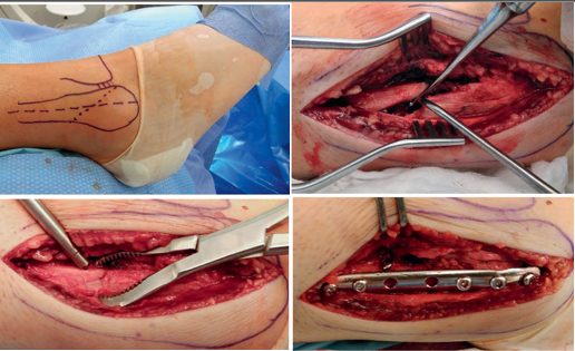 Рис. 20. Хирургический доступ и этапы остеосинтеза с использованием техники стягивающего винта и нейтрализующей пластины