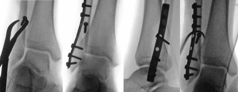 Рис. 21. Интраоперационный контроль с проведением hook-теста (теста крючка) для оценки стабильности межберцового синдесмоза