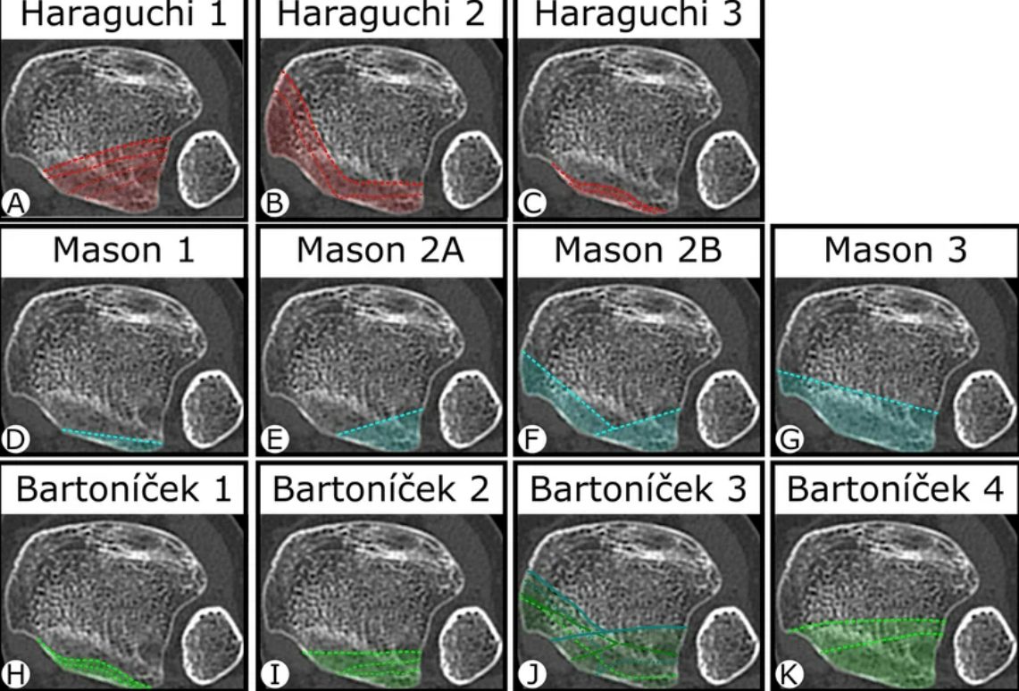 Рис. 10. Сравнение классификаций переломов лодыжек