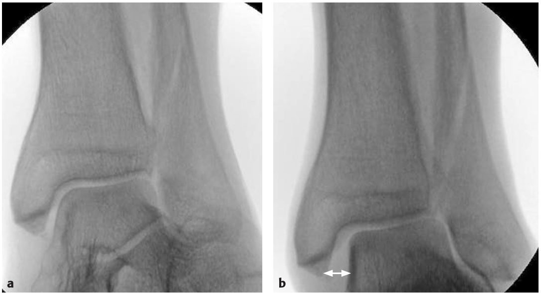 Рис. 28. Динамическая нестабильность голеностопного сустава при переломе Weber B, подтверждающая разрыв дельтовидной связки