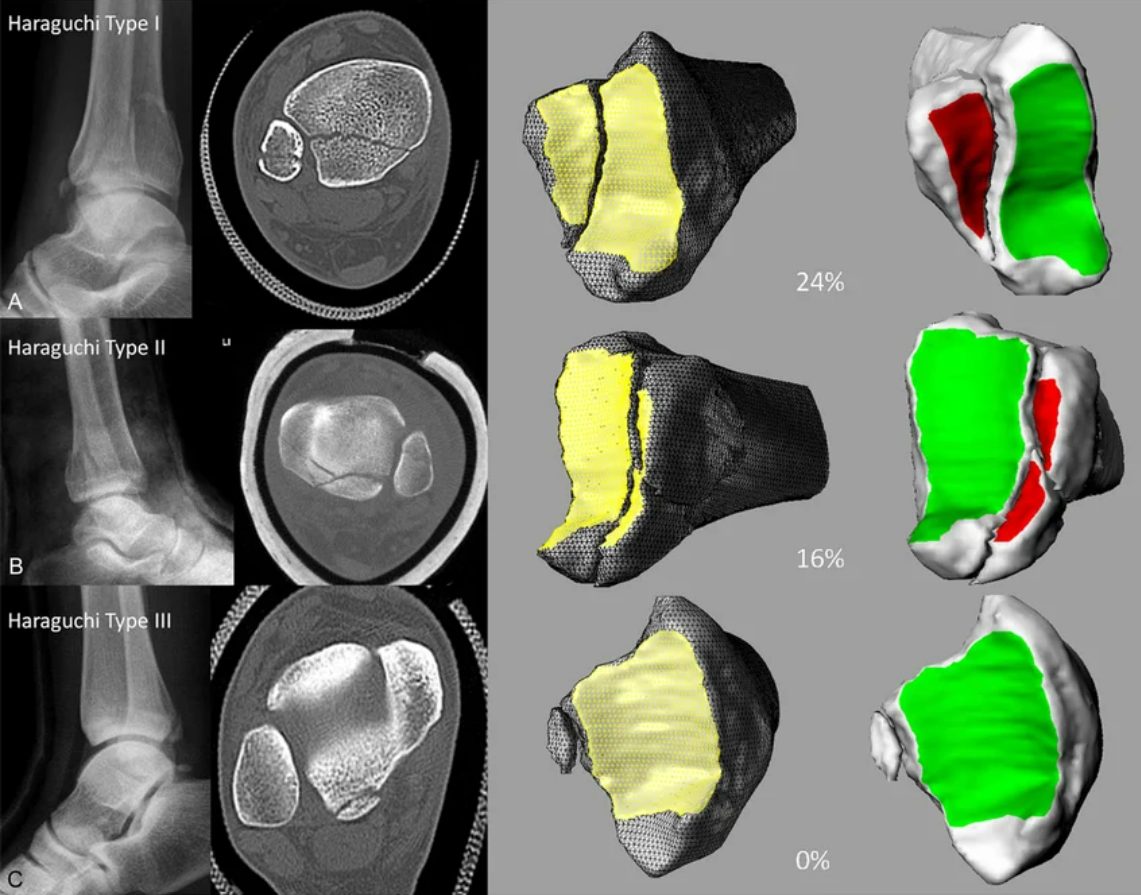 Рис. 8. Классификация переломов заднего края по Haraguchi