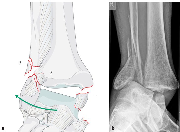 Рис. 6. Механизм пронации-абдукции (PA) по Lauge-Hansen, стадии I–III