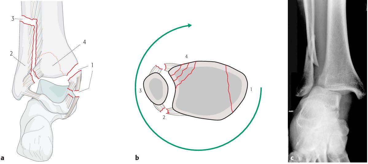 Рис. 7. Механизм пронации-наружной ротации (PE) по Lauge-Hansen, стадии I–IV