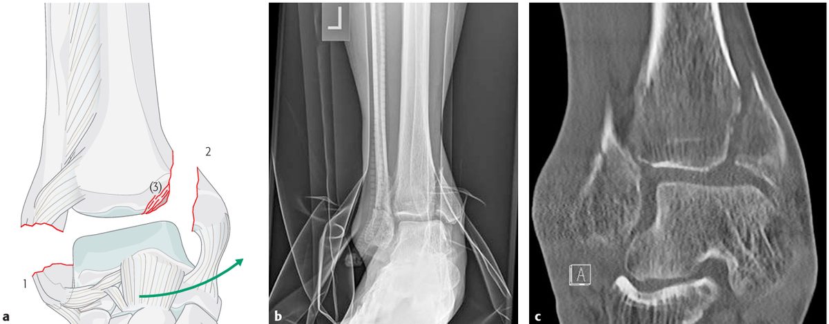 Рис. 4. Механизм супинации-аддукции (SA) по Lauge-Hansen, стадии I–III