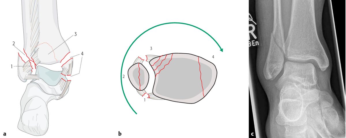 Рис. 5. Механизм супинации-наружной ротации (SE) по Lauge-Hansen, стадии I–IV