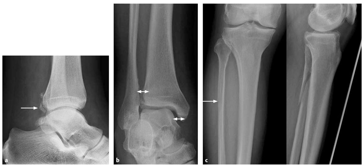 Рис. 29. Перелом Maisonneuve. Обратите внимание, что на стандартных снимках голеностопного сустава мы не видим перелом малоберцовой кости. Однако при выполнении рентгенографии на протяжении — перелом выявляется сразу