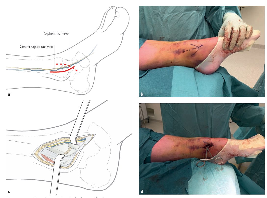 Рис. 23. Хирургический доступ к медиальной лодыжке