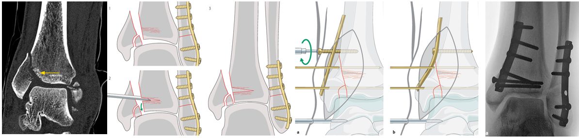 Рис. 25. Остеосинтез медиальной лодыжки с импакцией