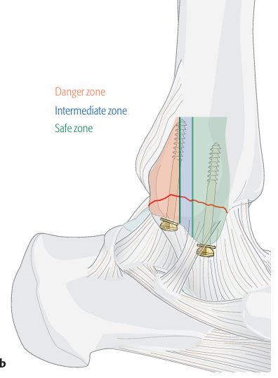 Рис. 24. Винтовая фиксация медиальной лодыжки (красным — зона риска повреждения сухожилия задней большеберцовой мышцы)
