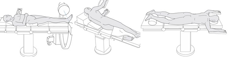 Рис. 18. Положение пациента на операционном столе