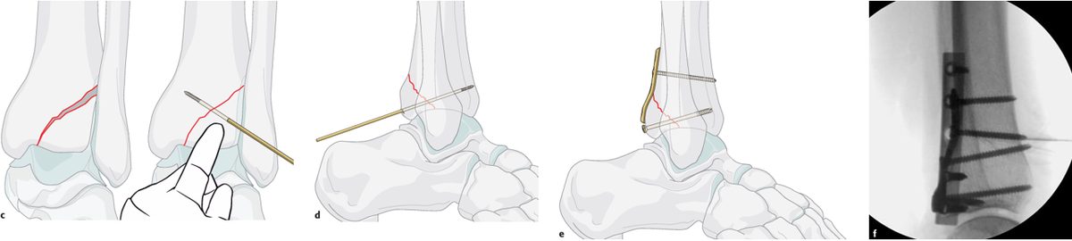 Рис. 27. Техника репозиции и фиксации заднего края