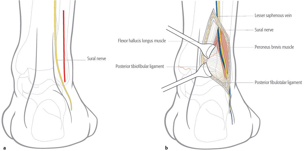 Рис. 26. Заднелатеральный доступ