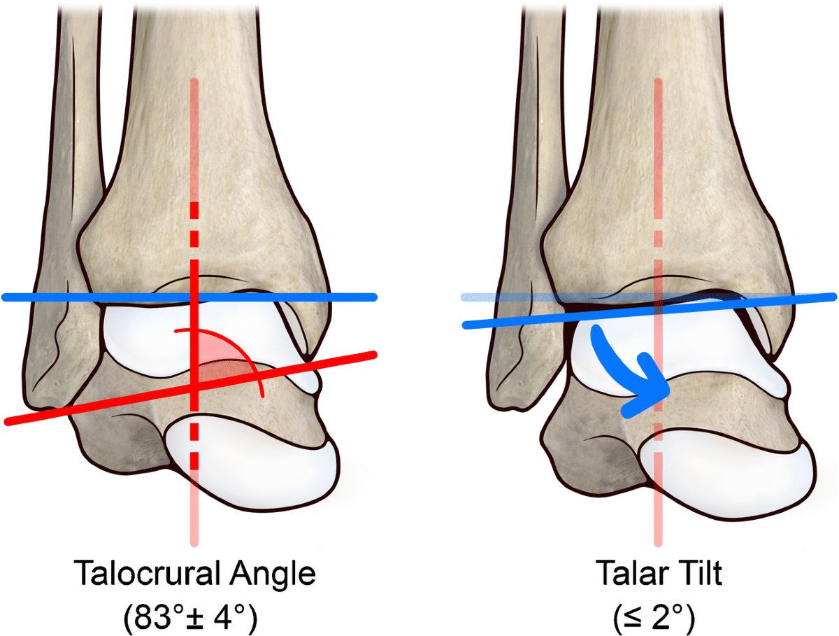 Рис. 14. Таранно-голеностопный угол (Sarkisian)