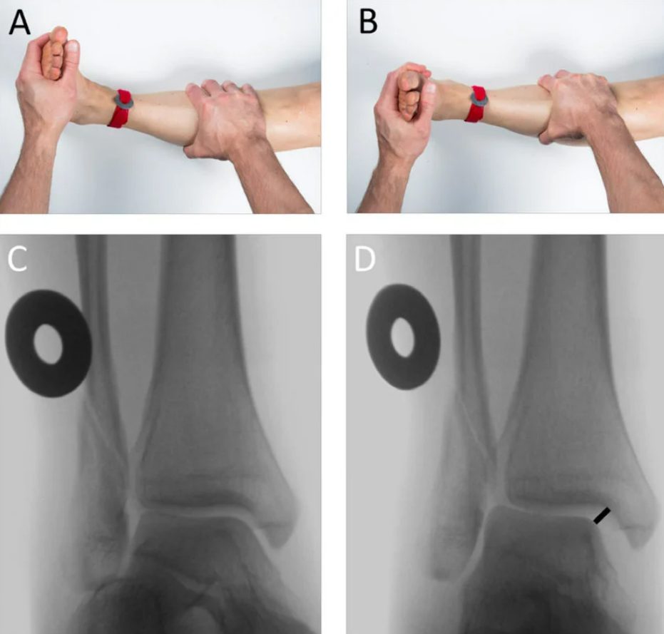 Рис. 16. Мануальный стресс-тест с наружной ротацией стопы