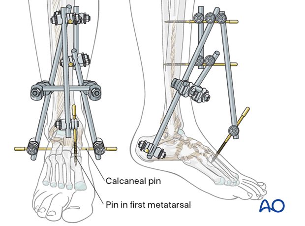 Рис. 17. Аппарат внешней фиксации (АВФ) при переломах лодыжек