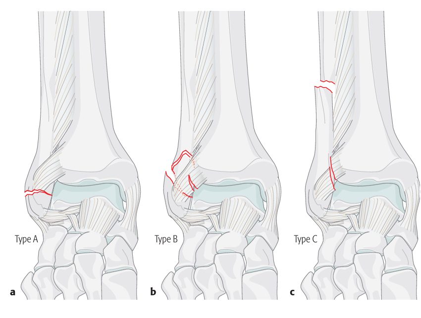 Рис. 3. Классификация переломов лодыжек по Danis-Weber