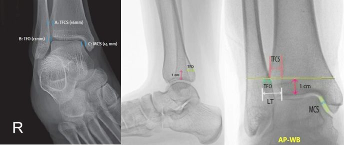 Рис. 12. Рентгенограммы голеностопного сустава в трёх проекциях
