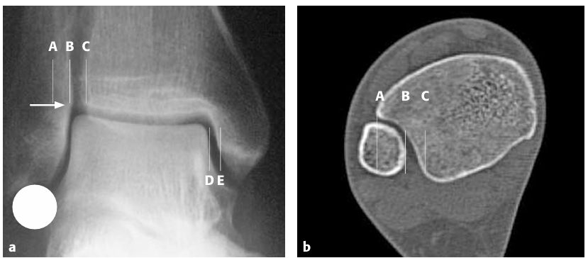 Рис. 13. Рентгенологические параметры голеностопного сустава
