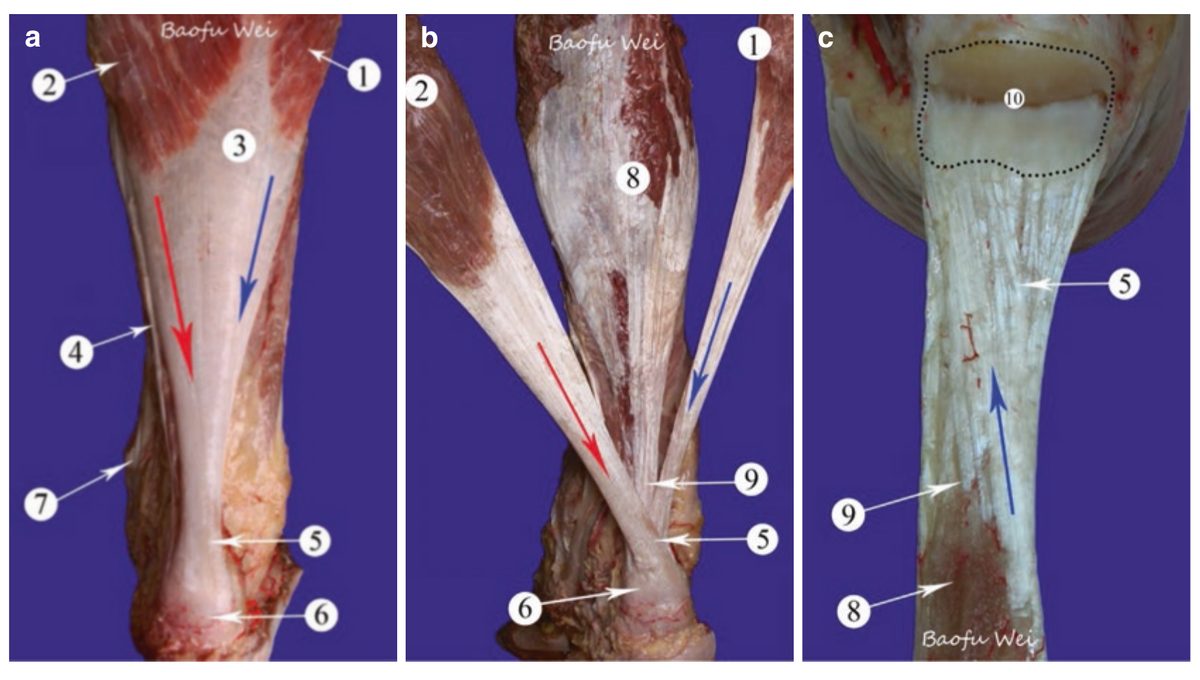 Торсия волокон ахиллова сухожилия