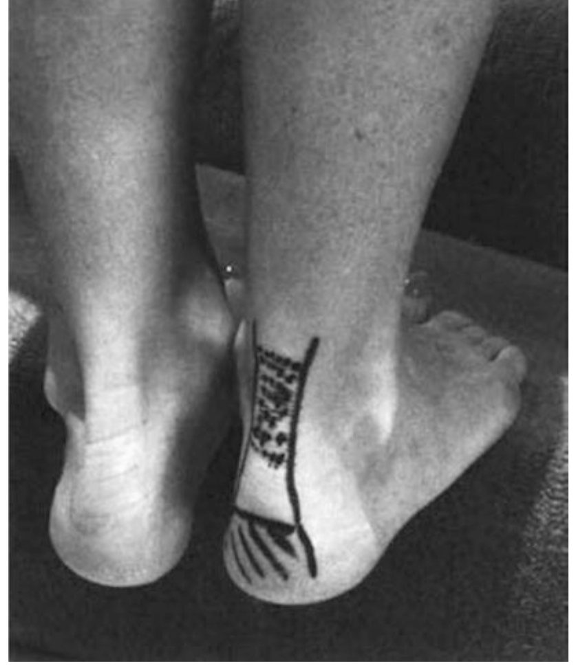 Эксцентрические упражнения — протокол Альфредсона