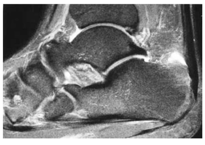 МРТ инсерционная тендинопатия и деформация Хаглунда