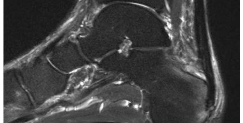 МРТ T2 — тендиноз ахиллова сухожилия